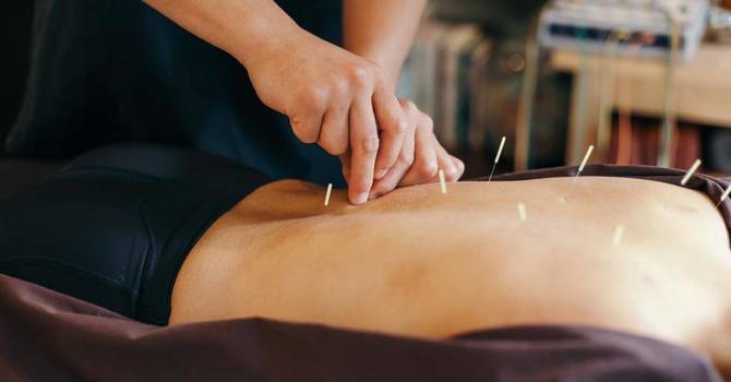 Acupuncture/Dry Needling/Cupping